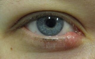 infecciones externas en el ojo: blefaritis y orzuelos