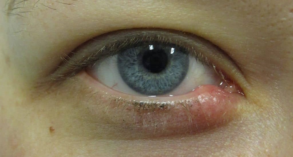 infecciones externas en el ojo: blefaritis y orzuelos