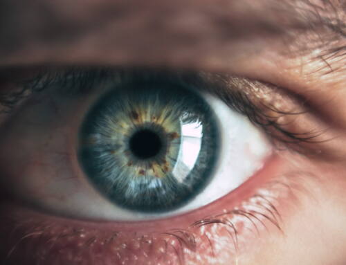 ¿Qué es el edema corneal?