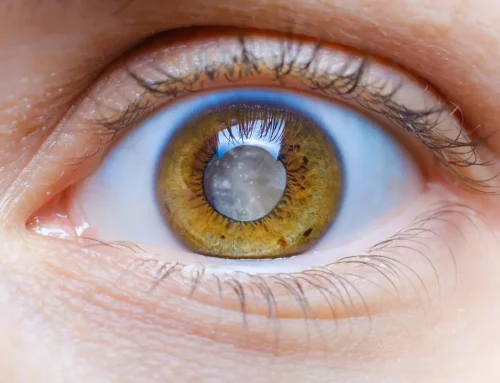 Catarata: identificación y tratamiento