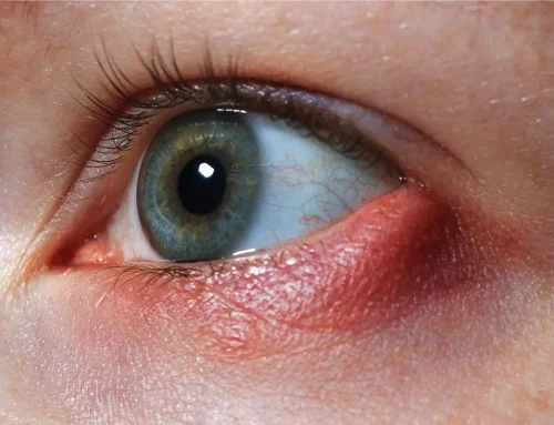 Todo sobre la conjuntivitis vírica