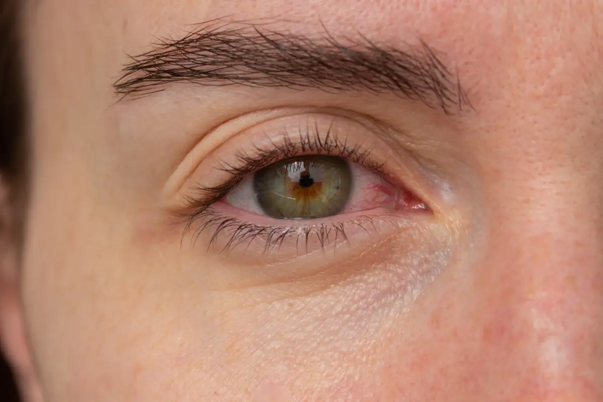 Conjuntivitis-2.webp