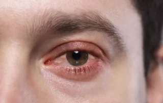 Conjuntivitis bacteriana