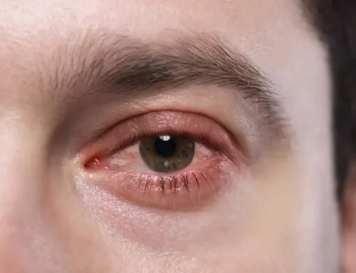 Conjuntivitis bacteriana: síntomas, contagio y tratamiento