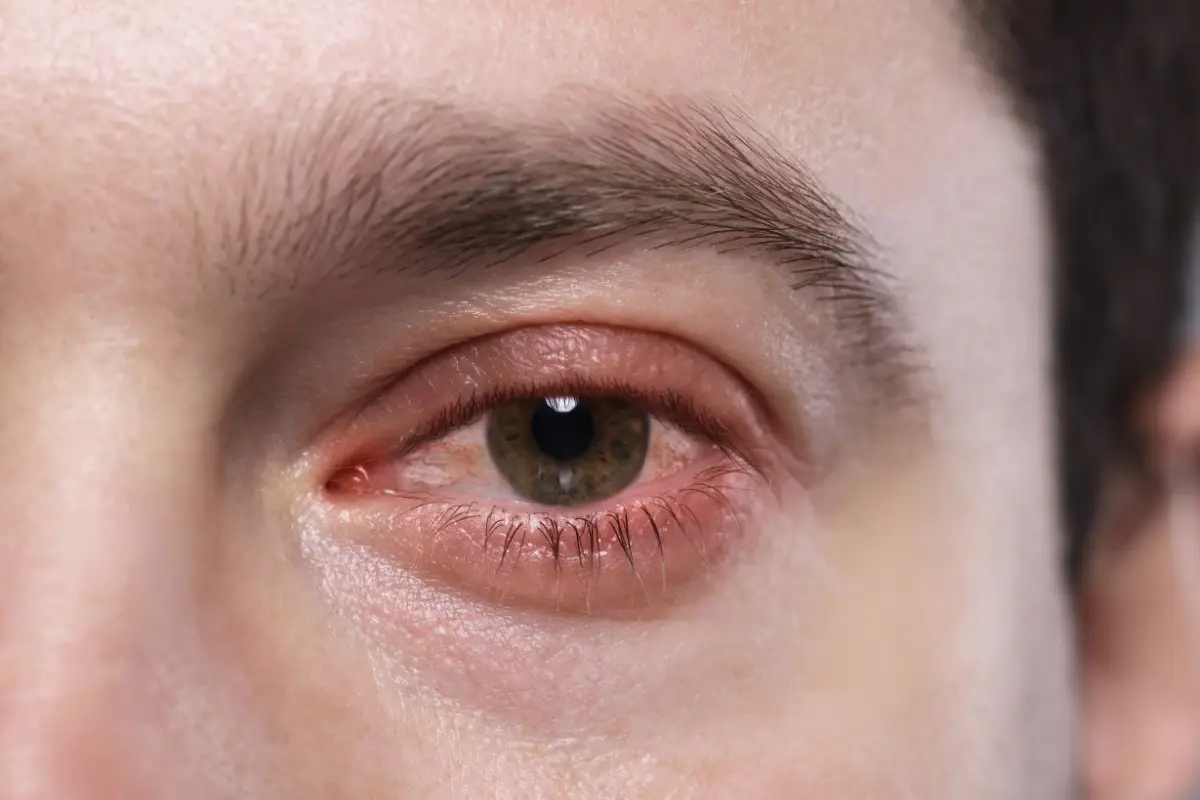 Conjuntivitis bacteriana