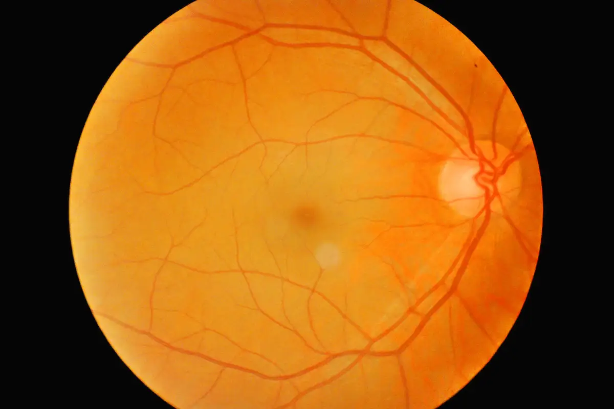 Retinopatía diabética ojo