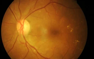 Desprendimiento de retina