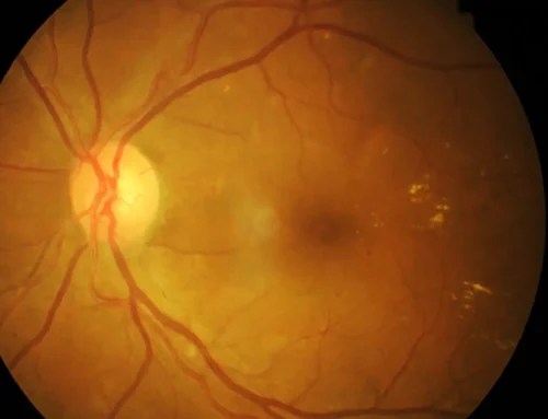 Desprendimiento de retina: señales de alerta y tratamientos