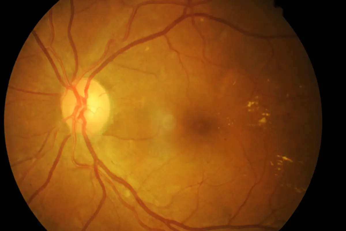 Desprendimiento de retina